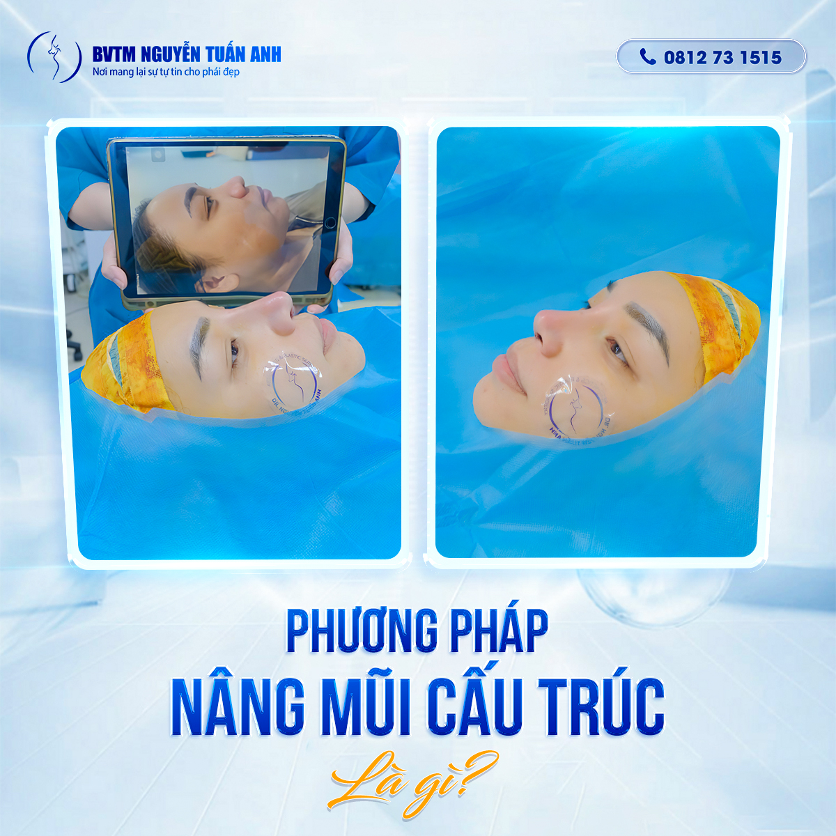 Nâng Mũi Sụn Tai Có Gây Nguy Hiểm Không